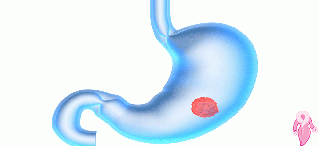 Mide Kanseri Belirtileri Tedavisi