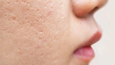 Tavuk Derisi (Keratosis Pilaris) Hastalığı Nedir? Tedavisi